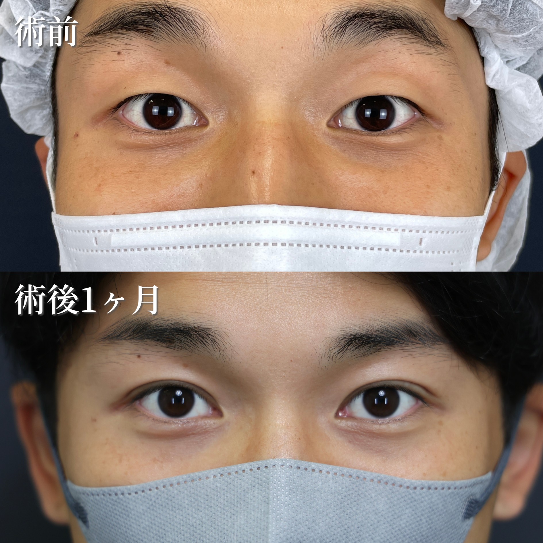 20代男性　二重埋没法