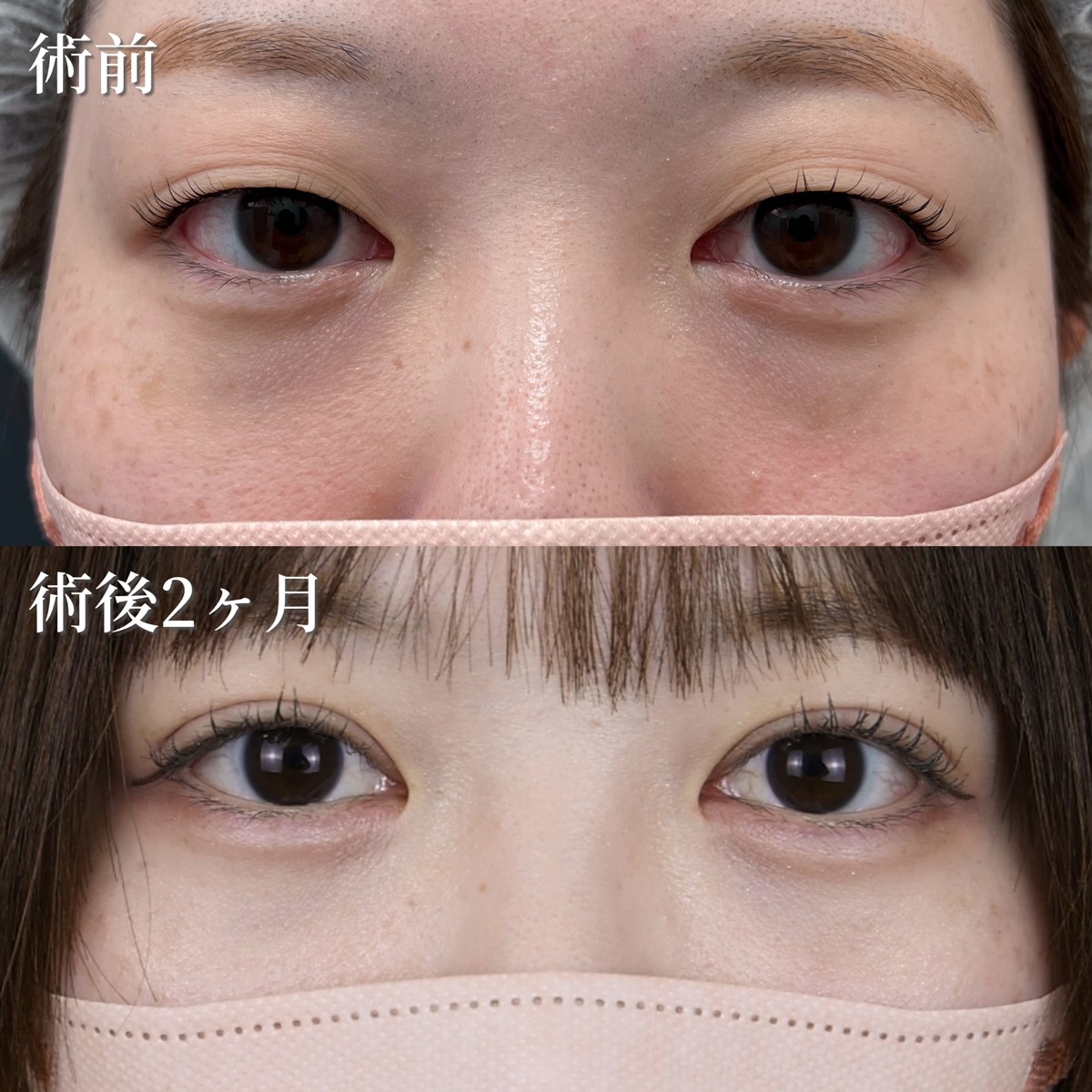 20代女性　二重埋没法