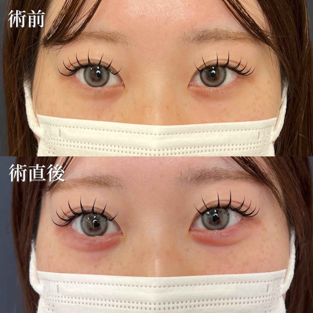 20代女性　涙袋ヒアルロン酸