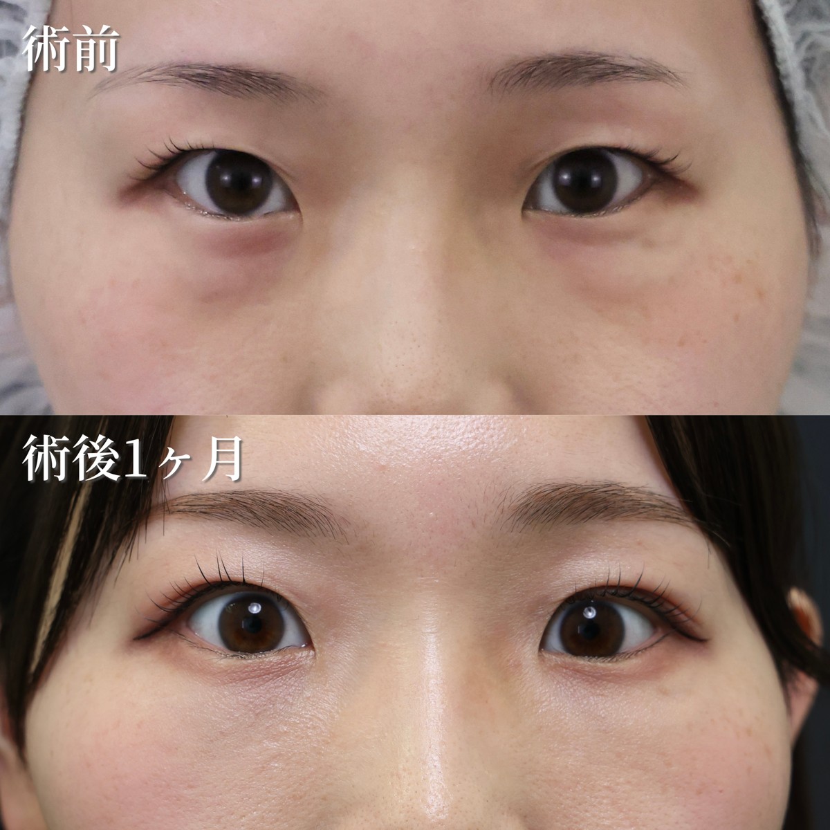 30代女性　目の下のクマ取り・たるみ取り
