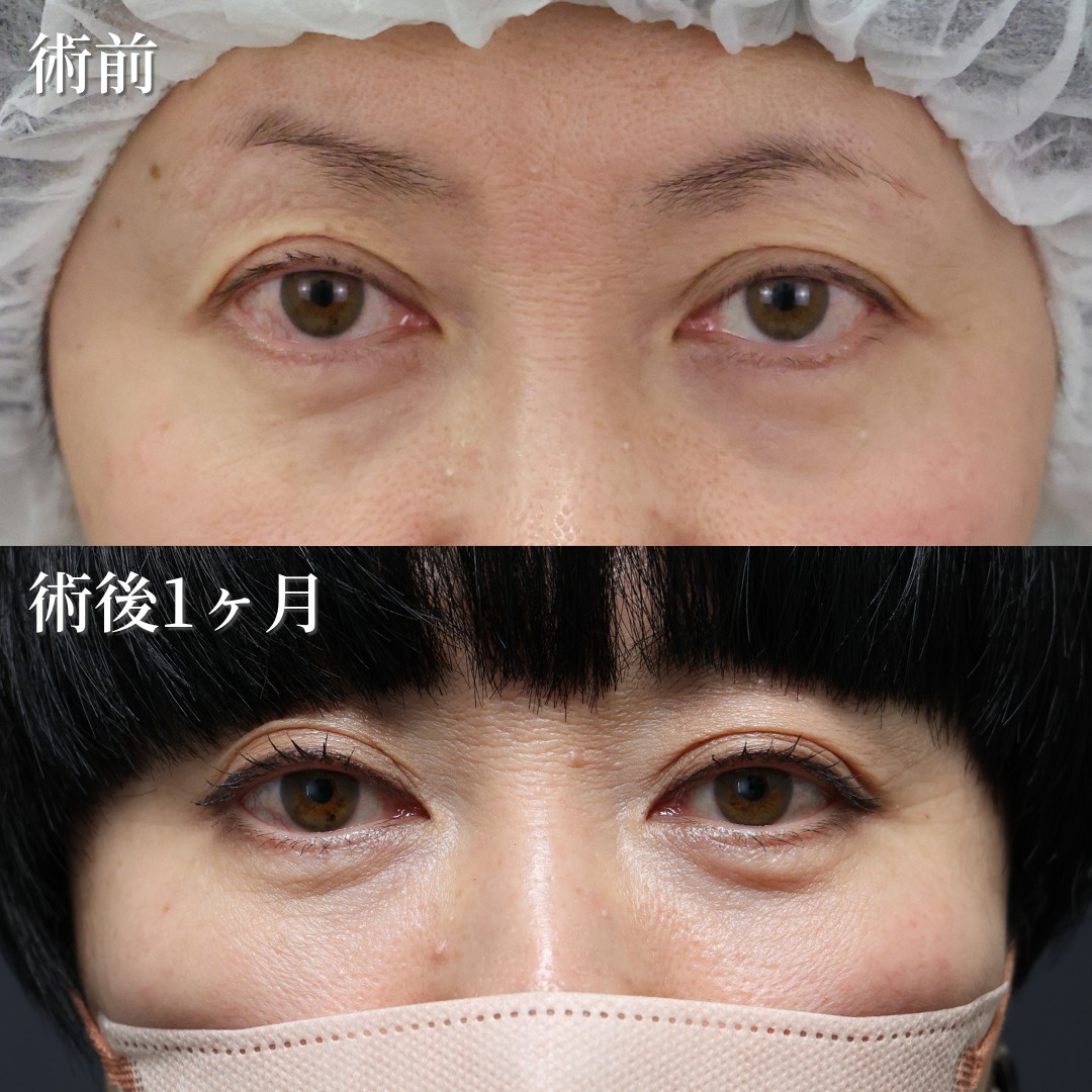 40代女性　裏ハムラ法