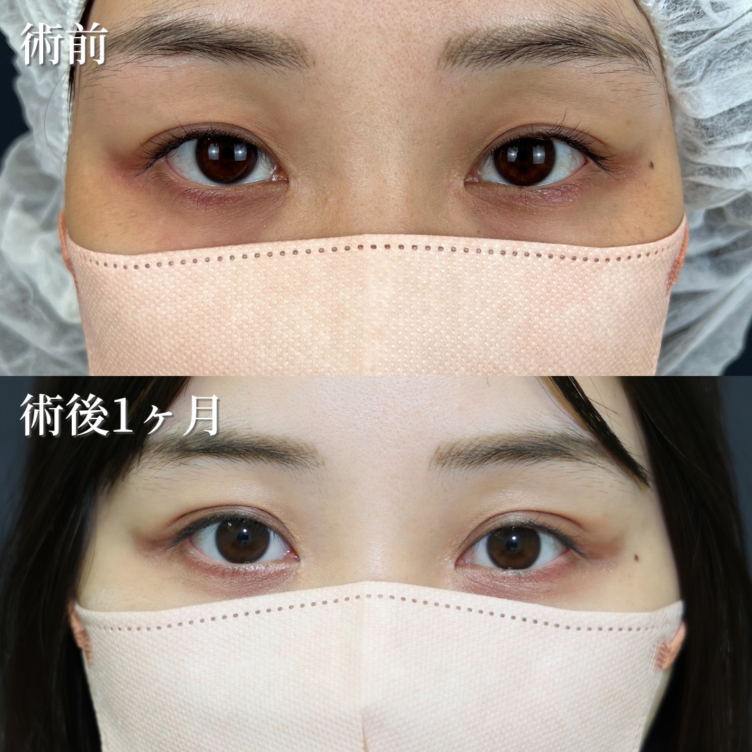 20代女性　二重埋没法