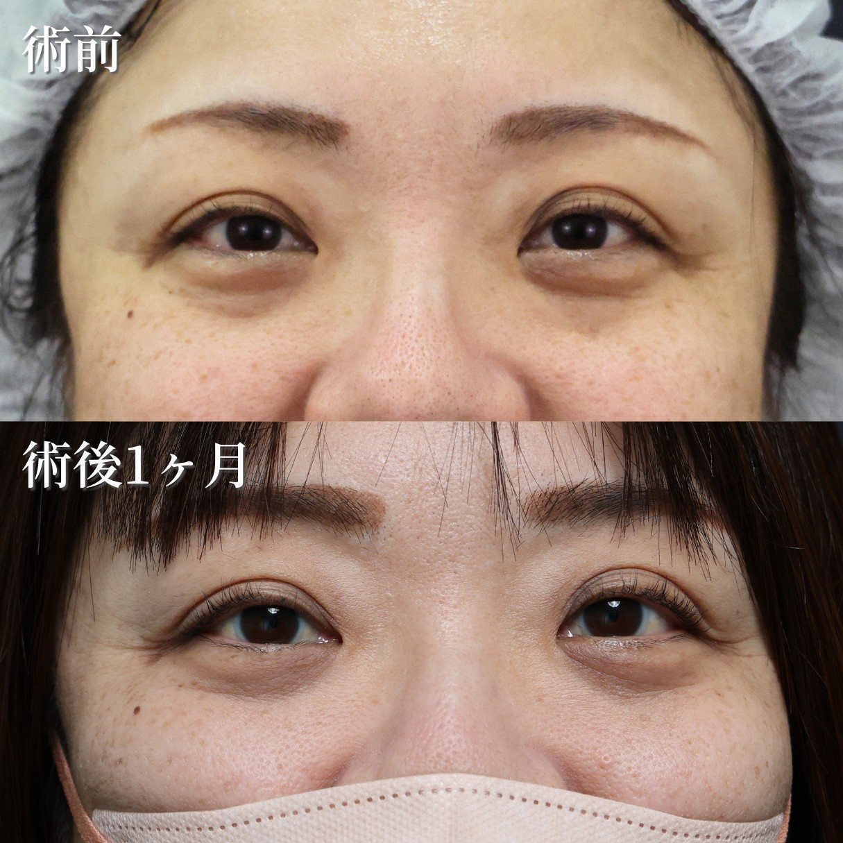 50代女性　裏ハムラ