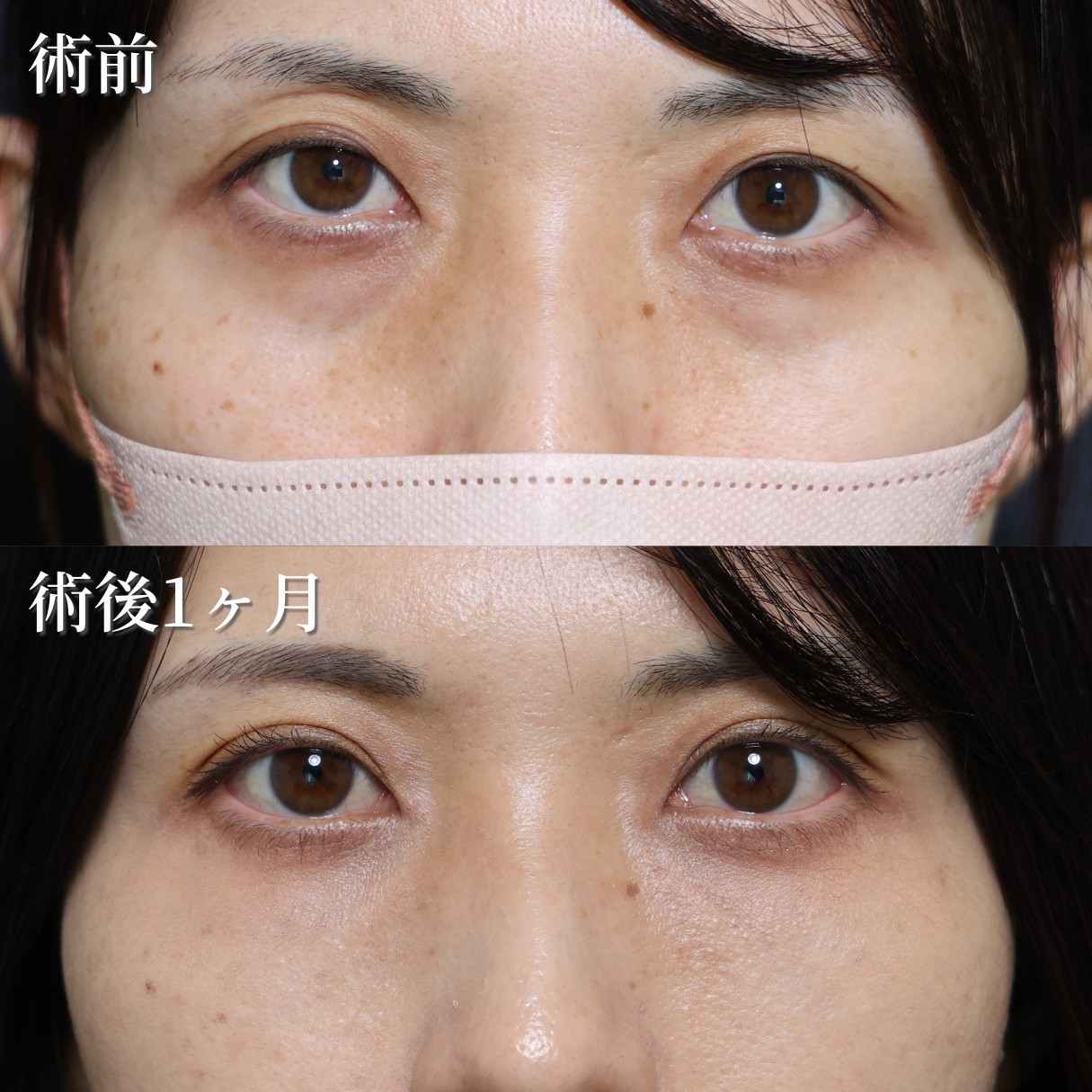 40代女性　切らない目の下のクマ・たるみ取り