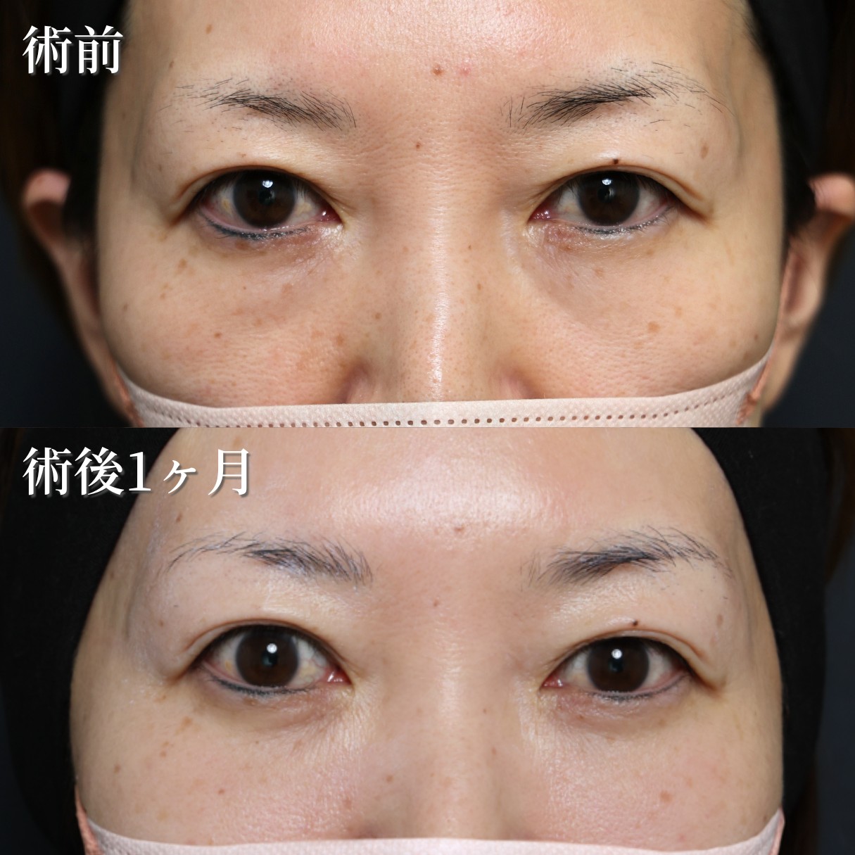 40代女性　目の下の切らないクマ・たるみ取り＋脂肪注入