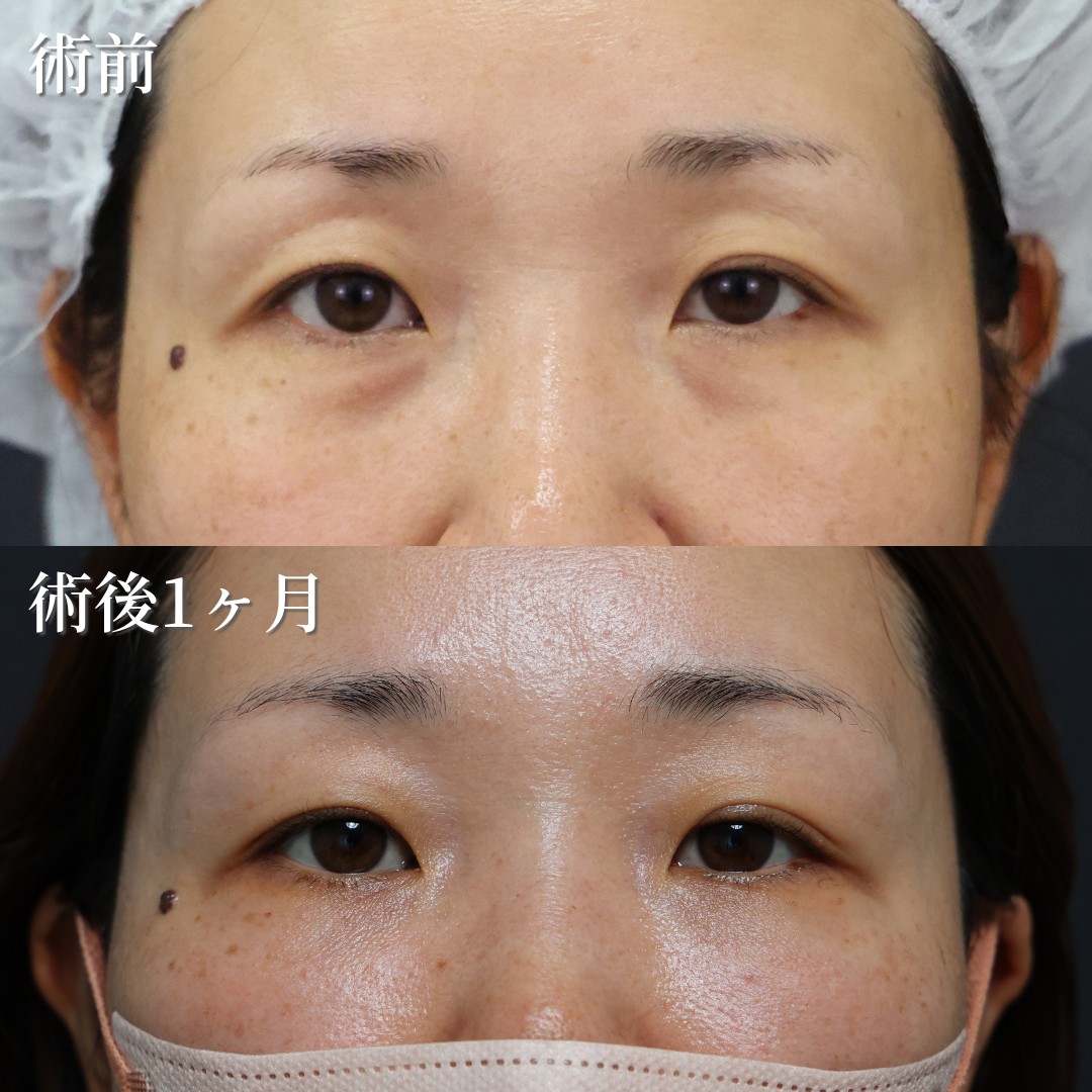 40代女性　裏ハムラ