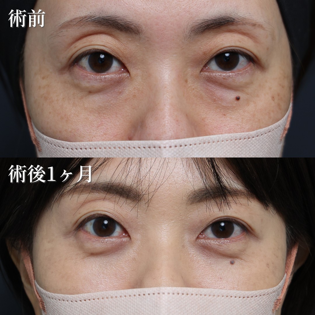 40代女性　クマ取り　脂肪注入