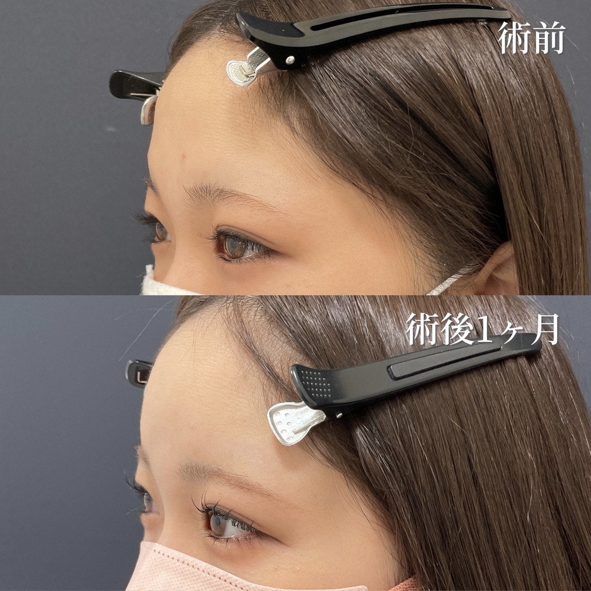 20代女性　ヒアルロン酸