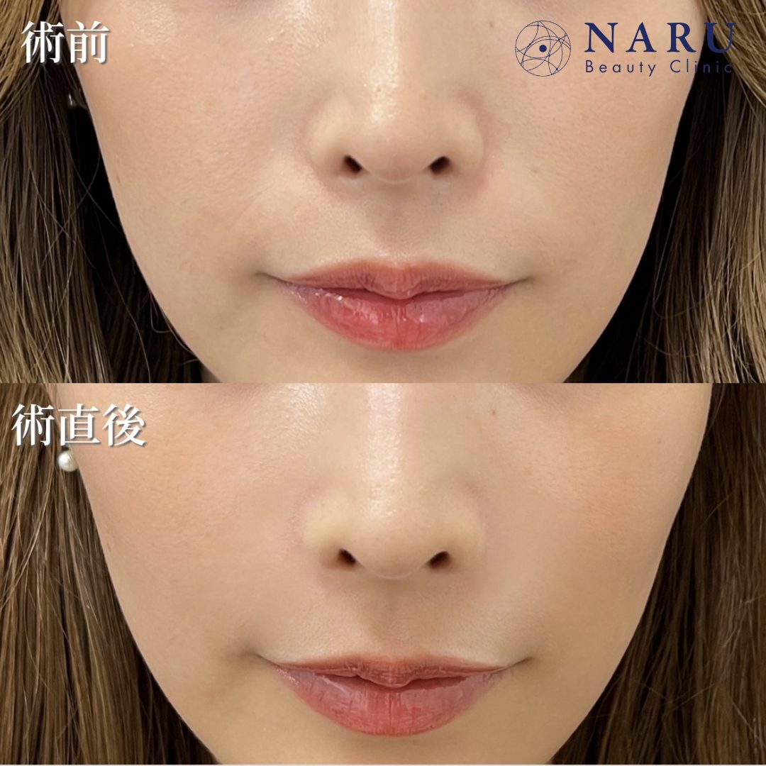 20代女性　貴族ヒアルロン酸