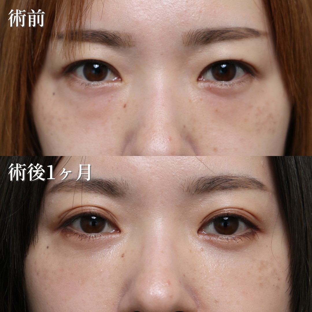 30代　裏ハムラ