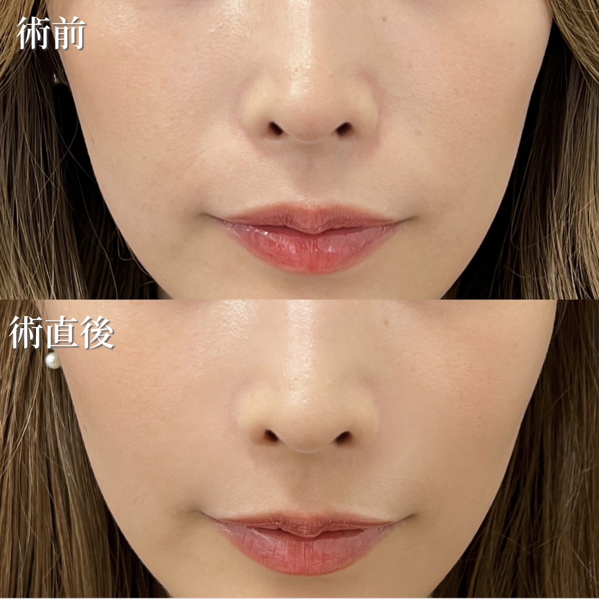 20代女性　ヒアルロン酸