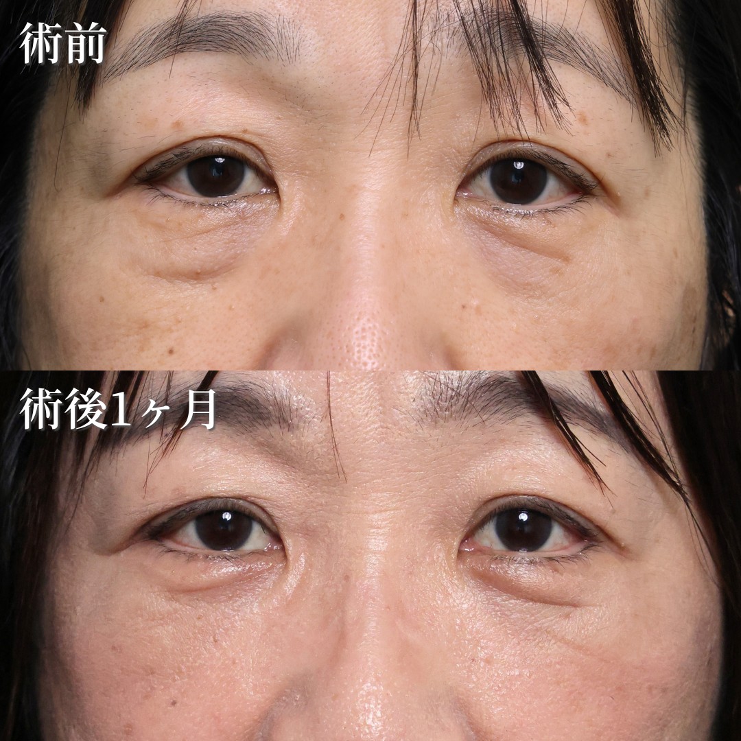 50代女性　ハムラ法＋目の下の脂肪注入