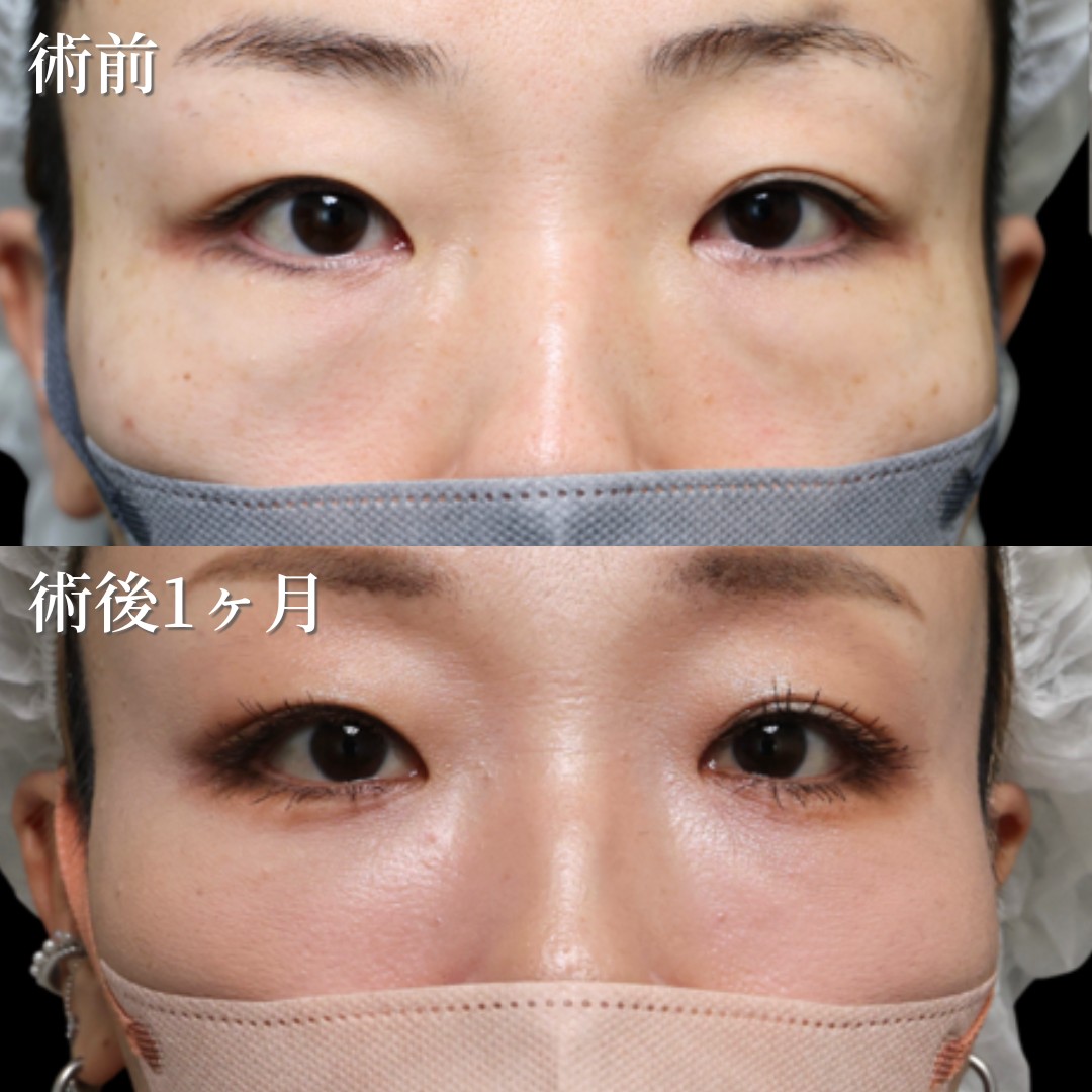 40代女性　裏ハムラ法