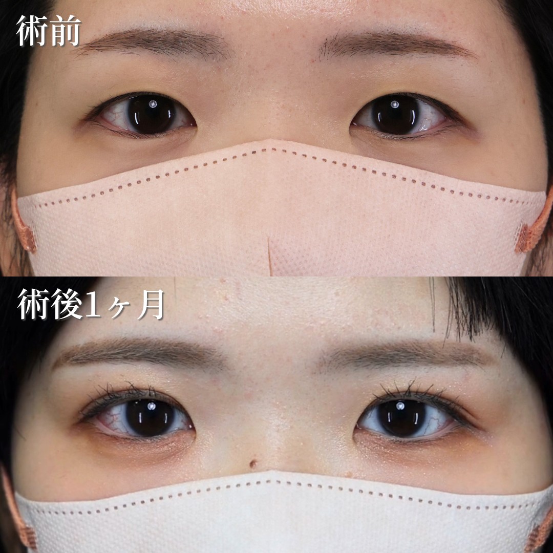 20代女性　二重埋没法