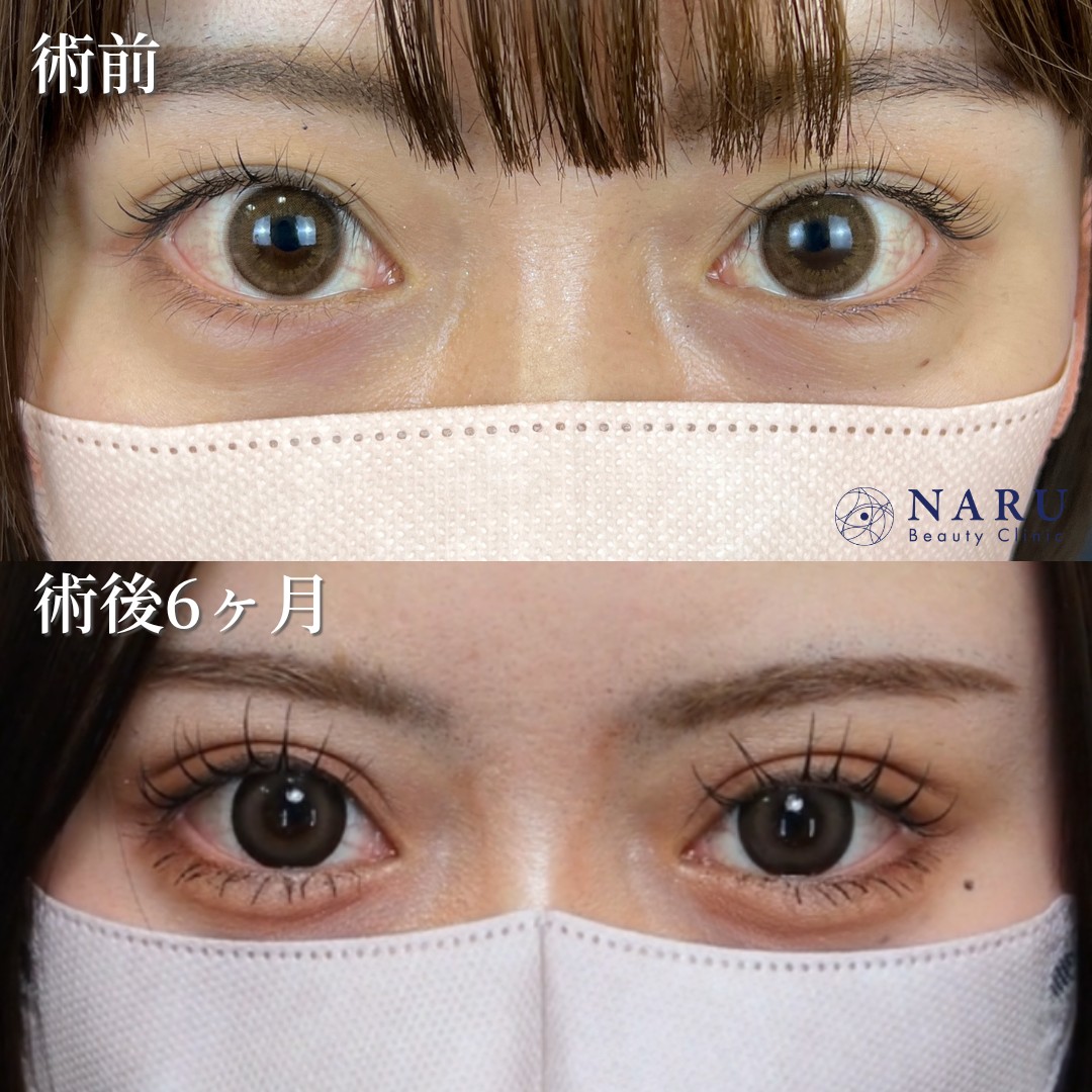 20代女性　二重埋没法